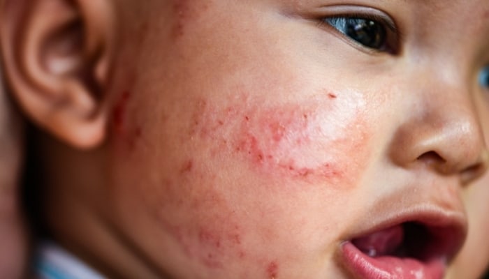 child with rash from food
