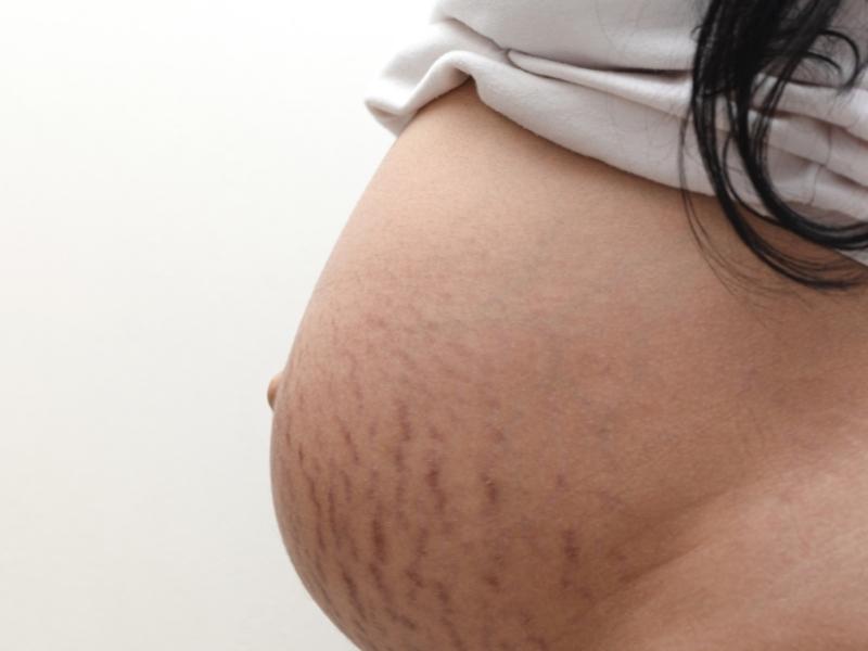 Does Tanning Get Rid of Stretch Marks? Parents Plus Kids
